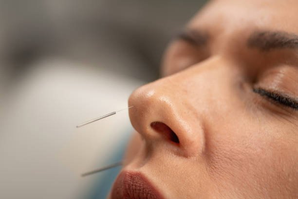 Acupuntura para La parálisis Facial