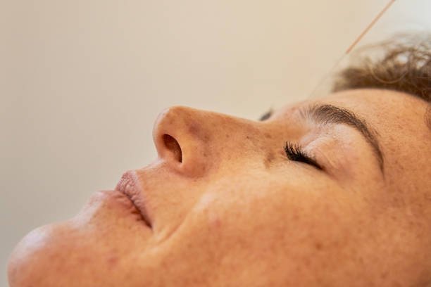 Yintang uno de los Puntos de Acupuntura para Dormir Profundamente