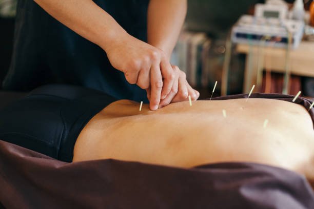 ACUPUNTURA PARA EL CIATIALGIA