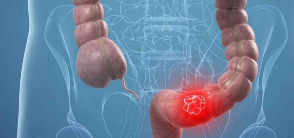 Acupuntura para el Síndrome del Intestino Irritable