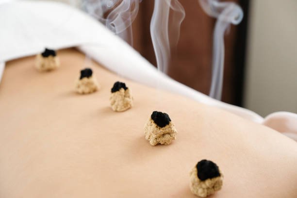 6 Herramientas Ancestrales de la MTC: Más Allá de las Agujas de Acupuntura 9 conos de moxa en moxibustion directa en la piel