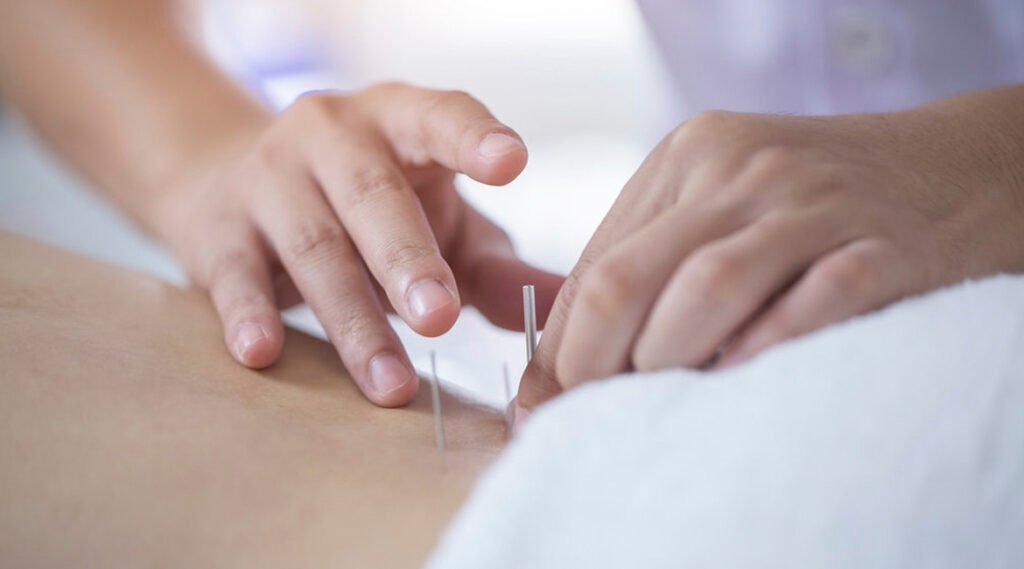 agujas de acupuntura en el consultorio medico aliviate