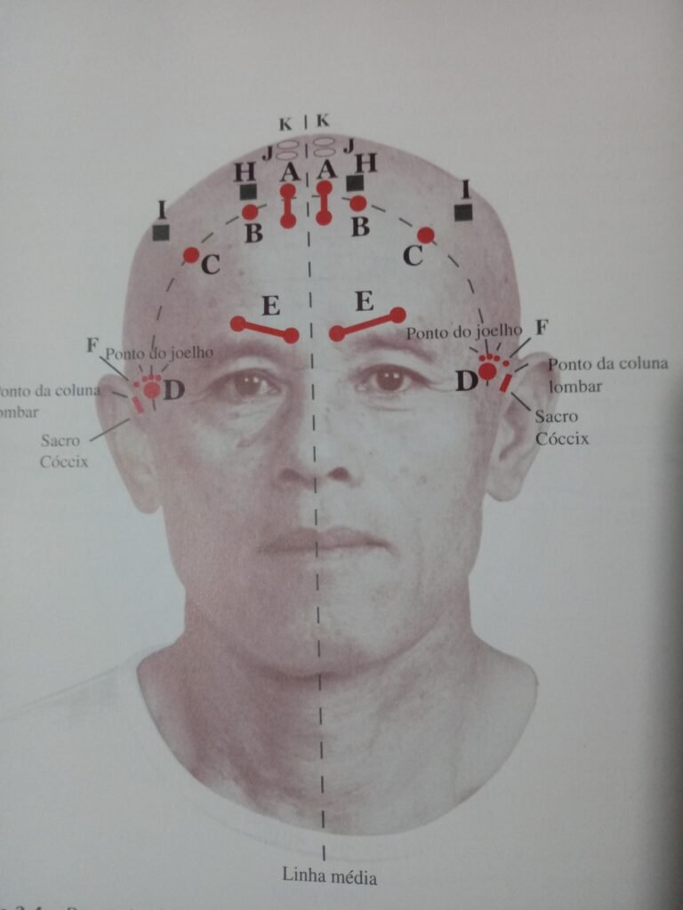 Craneoacupuntura: Integración de la Medicina Tradicional China y la Neurociencia Moderna en la Rehabilitación Neurológica 6 craneopuntura 2