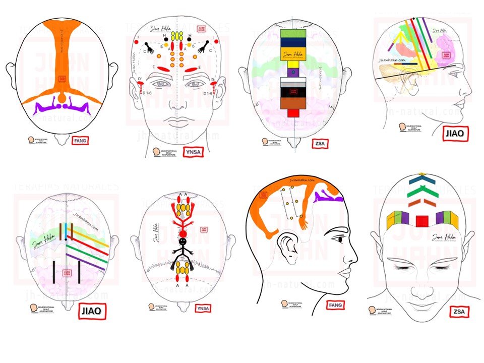 Craneoacupuntura: Integración de la Medicina Tradicional China y la Neurociencia Moderna en la Rehabilitación Neurológica 3 enfoques diversos de la craneopuntura