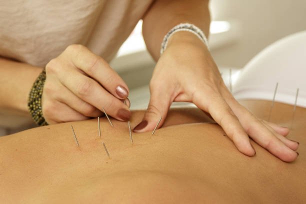 Tratamiento Integral de la Colitis Ulcerosa: 1 Enfoque Basado en Evidencia y Medicina Alternativa 7 acupuntura y medicina china tradicional para la colitis
