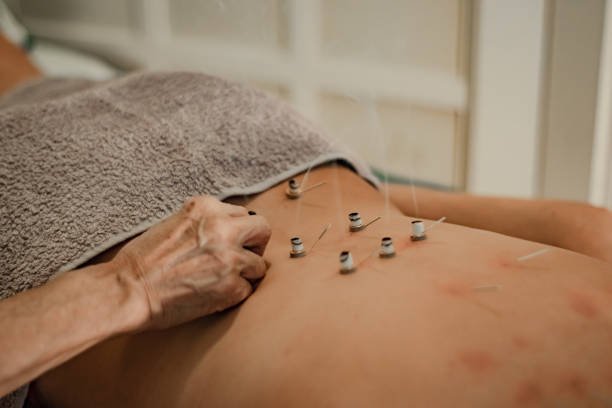La Moxibustión China: 1 Terapia Sencilla, un Fuego con Raíz 4 La Moxibustión directa con conos de altamisa