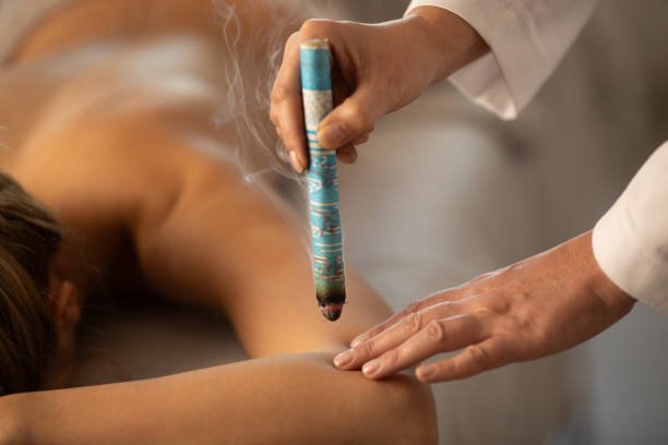 La Moxibustión China: 1 Terapia Sencilla, un Fuego con Raíz 3 La Moxibustión INDIRECTA con Moxa indirecta