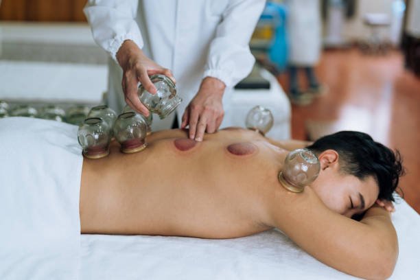 🪡 5 señales de que podrías beneficiarte de una sesión de acupuntura 2 SESION DE VENTOSAS COMPLEMENTO DE LA SESION DE ACUPUNTURA EN CONTRACTURAS