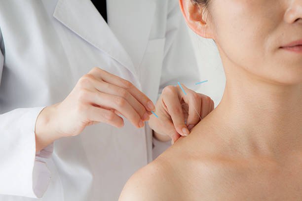 🪡 5 señales de que podrías beneficiarte de una sesión de acupuntura 7 SESION DE ACUPUNTURA PARA EL ESTRES EN ALIVIATECONMIGO