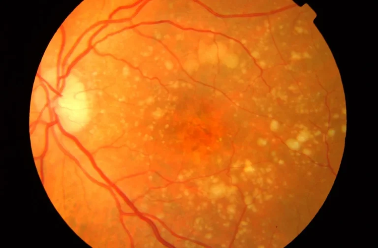 1.Transforma tu Visión: Tratamiento Holístico de la Degeneración Macular con Medicina China Tradicional