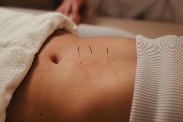1. Acupuntura para Fertilidad en Medellin 5 tratamiento de Acupuntura para Fertilidad en Medellin