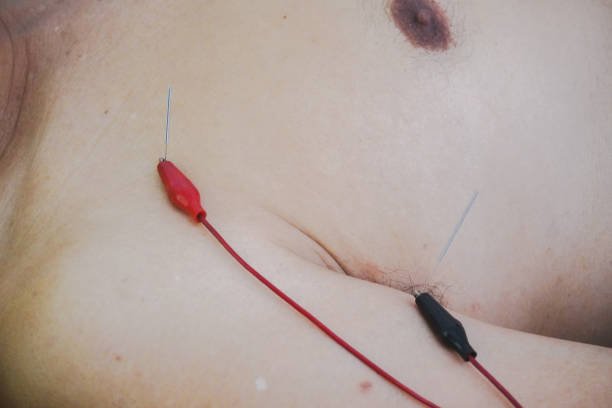 1 Prevención del Infarto con Medicina China Tradicional 4 puntos de acupuntura para evitar los infartos del miocardio