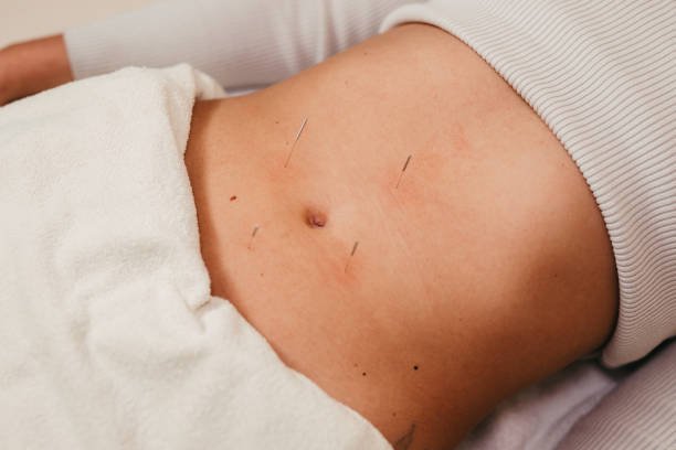 Acupuntura para vejiga hiperactiva: 1 visión desde la Medicina Tradicional China 4 puntos abdominales para la vejiga hiperactiva