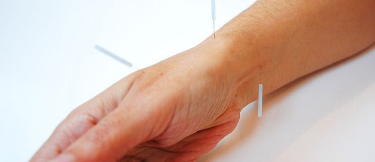 acupuntura para la inflamacion del tunel del carpo