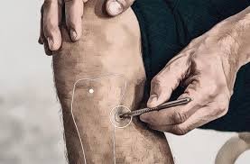 Acupuntura para el Vértigo 7