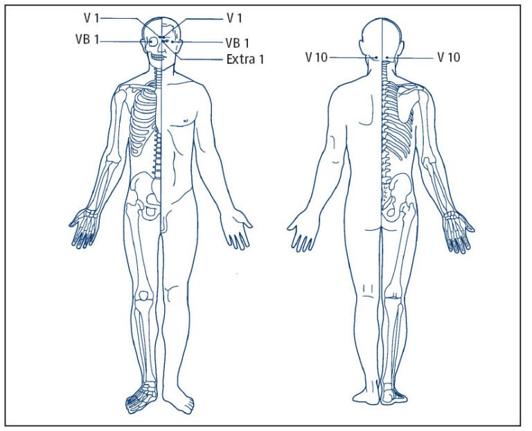 Acupuntura para el Vértigo