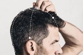 Acupuntura para el Vértigo 6