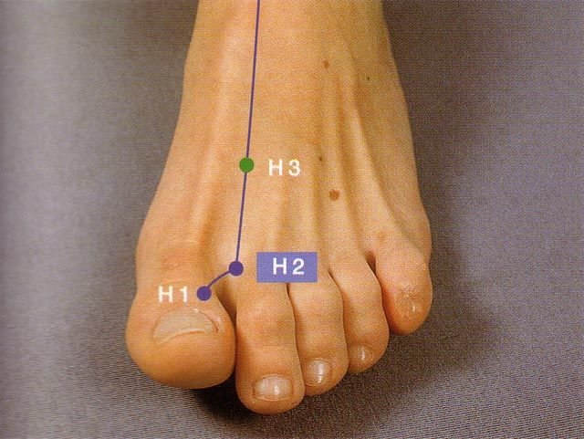 Acupuntura para el Vértigo 4