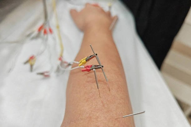 Más allá del quirófano: Preparación prequirúrgica con acupuntura 4