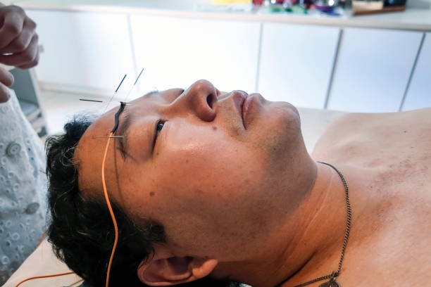 Puntos de acupuntura para parálisis facial: E4 Dicang, E6 Jiache, IG4 Hegu, TR17 Yifeng – tratamiento natural parálisis de Bell